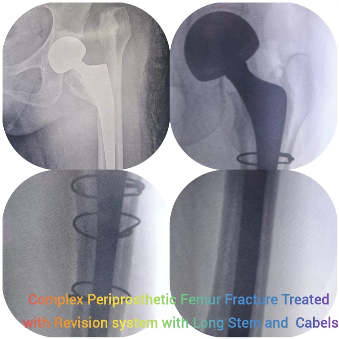 Revision hip replacement